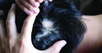 Alopecia Areata Procedure Treatment