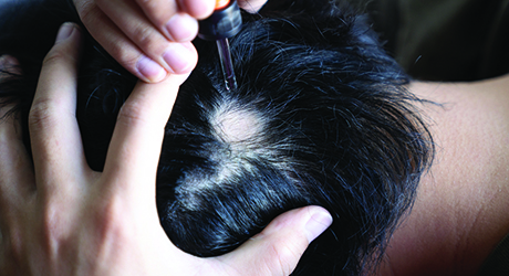 Alopecia Areata - Adore