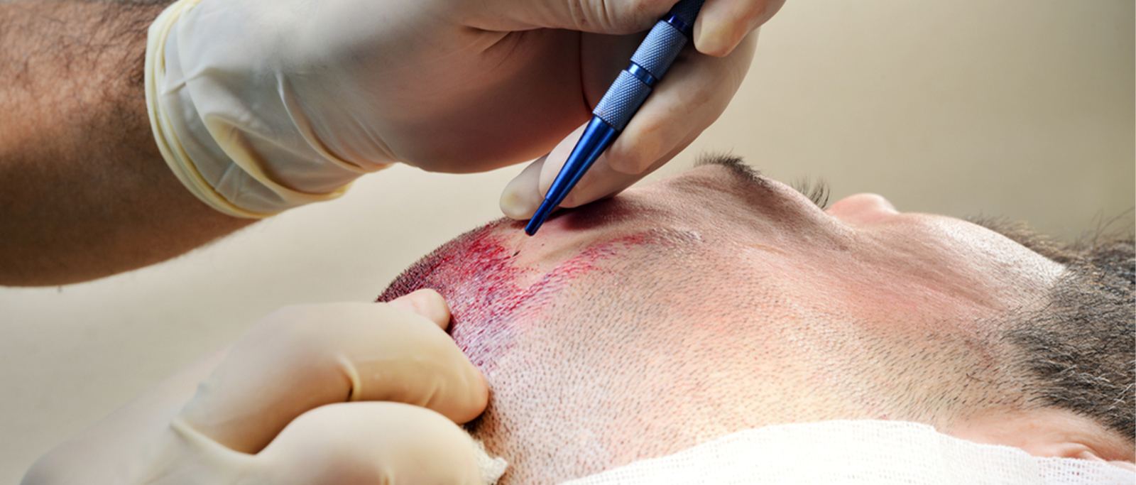 Hair Transplant Services - Adore Skin Clinic